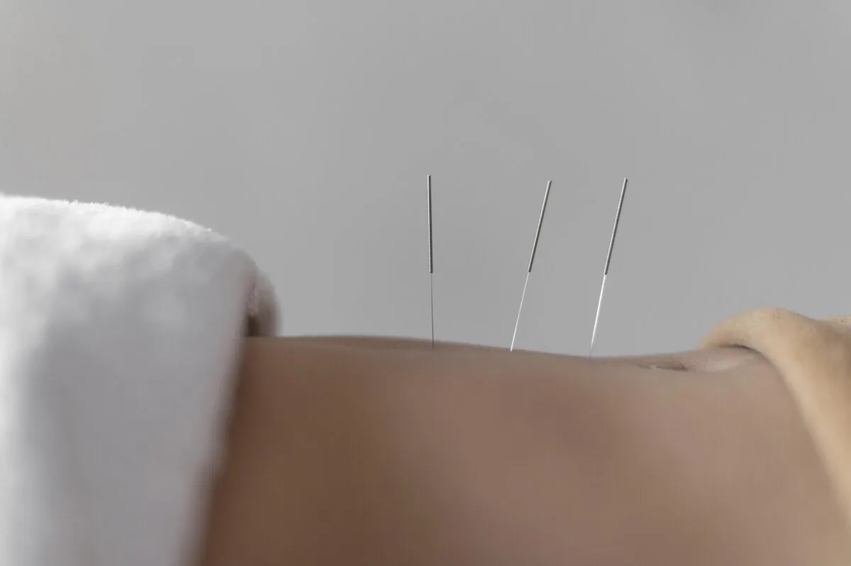 A practitioner's hand guiding needle placement during treatment at our Manhattan clinic